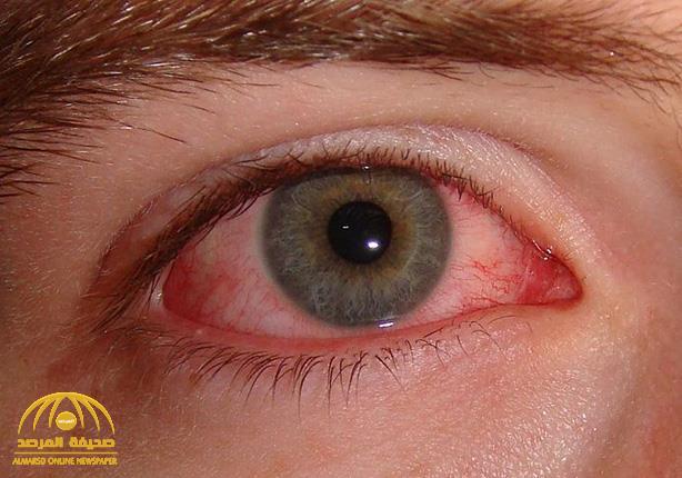 فيديو.. "استشاري" يكشف أسباب ارتفاع معدلات الإصابة بـ"جفاف العين"