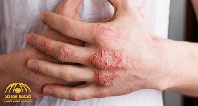 الكشف عن أعراض وأسباب "أكزيما" الجلد المؤلمة.. وكيفية علاجها!