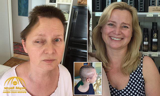 شاهد : صور صادمة لإزالة جزء كبير من رأس امرأة ..والسبب مفاجأة !