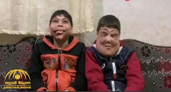 "كأنهما يرتديان أقنعة رعب".. شاهد: وجه طفلين في مصر يتضخم بطريقة غريبة!