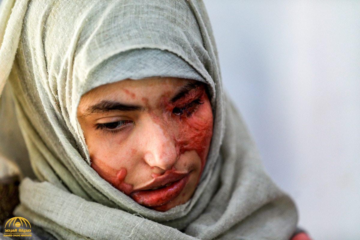 شاهد: يمني حوثي يشوه وجه طليقته بـ"الأسيد".. والضحية تكشف عن تفاصيل زواج الجحيم!
