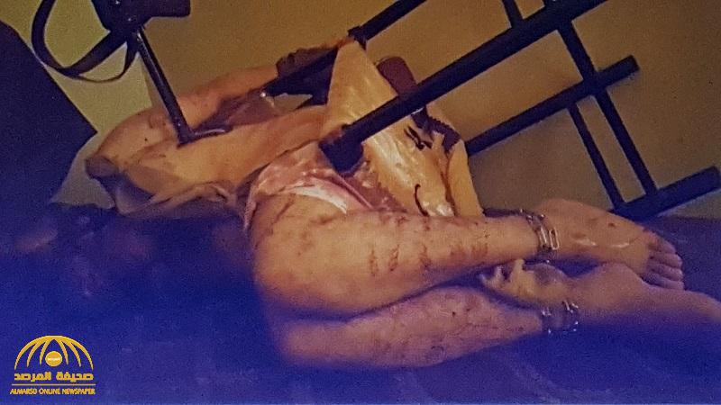 شاهد .. صورة صادمة ليمني عذبه الحوثيون حتى أصيب بالشلل