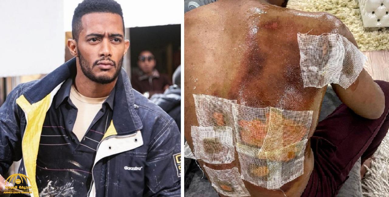 شاهد: الفنان محمد رمضان يكشف عن أول صورة لإصابته المروعة في الظهر