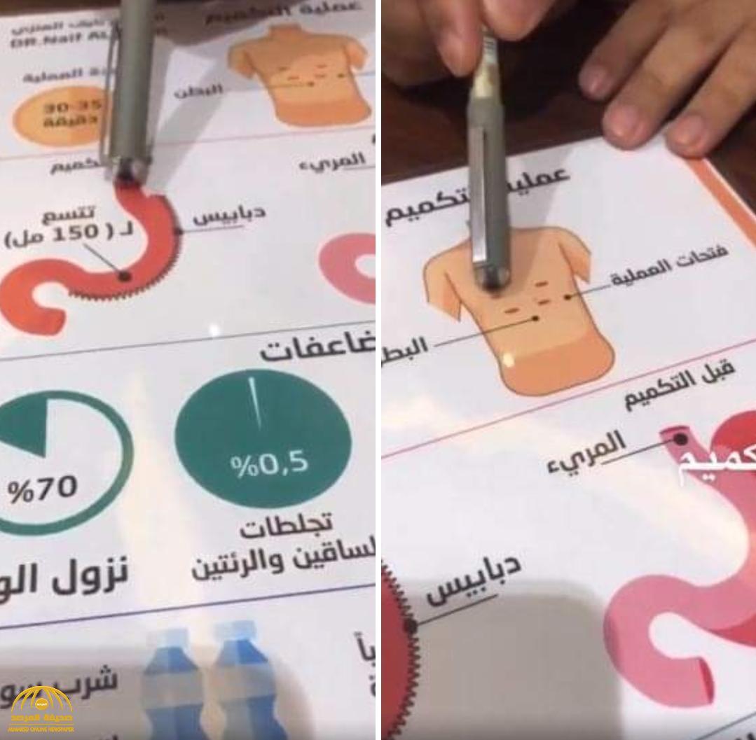بالفيديو.. طبيب سعودي يشرح طريقة "تكميم المعدة" لإنقاص الوزن