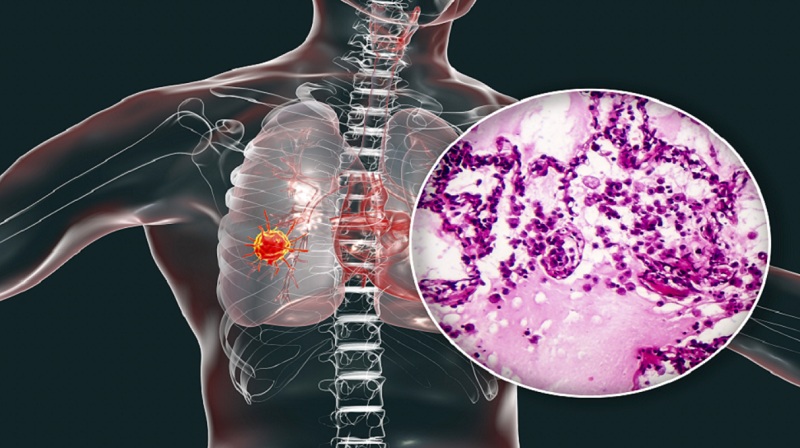 خمس "علامات وأعراض مفاجئة" قد تدل على الإصابة بسرطان الرئة