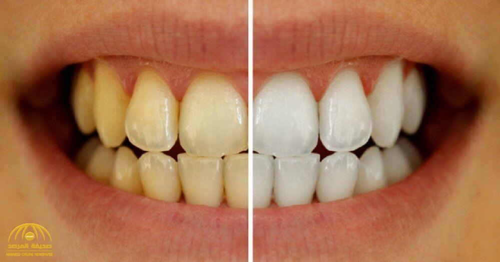 تعرف على طريقة سهلة لمنع  تسوس الأسنان والمحافظة على صحة الفم بشكل دائم