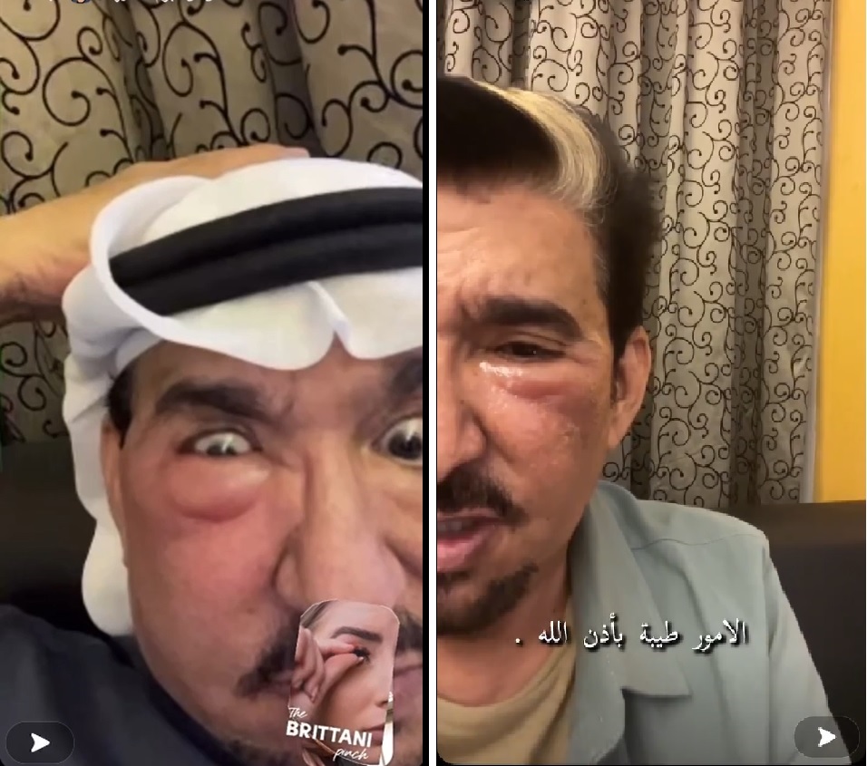شاهد .. عبدالله السدحان يفاجئ متابعيه بوجه منتفخ وعيون متورمة