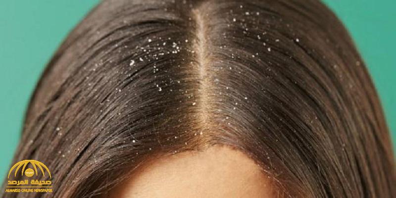 دراسة طبية تكشف عن سبب غريب لتكوّن "قشرة الشعر"