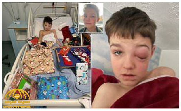 شاهد: طفل بريطاني تكاد أن تنفجر عيناه ويصاب بالعمى.. والسبب " فيروس كورونا "